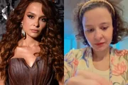 Luta de Maiara contra alopecia reacende debate sobre transplante capilar