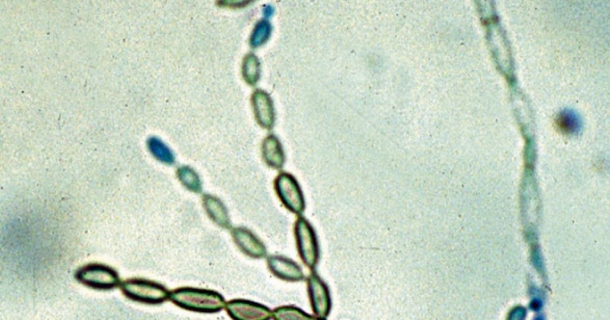 Fungo mortal que ‘derrete’ o cérebro se espalha, e cientistas nos EUA não sabem o porquê